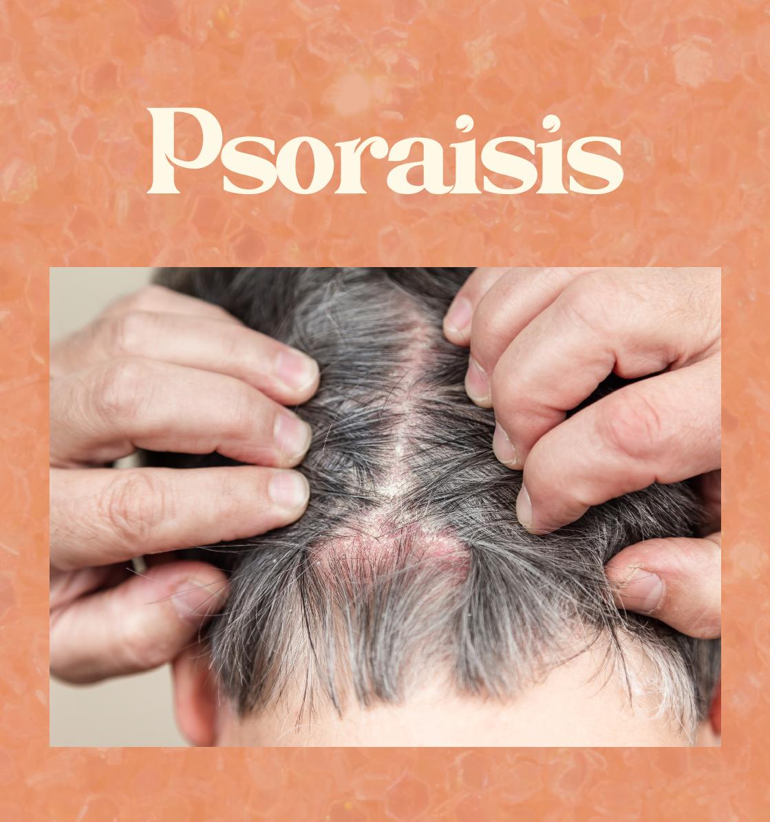 Understanding and Managing Psoriasis: Your Guide to Relief