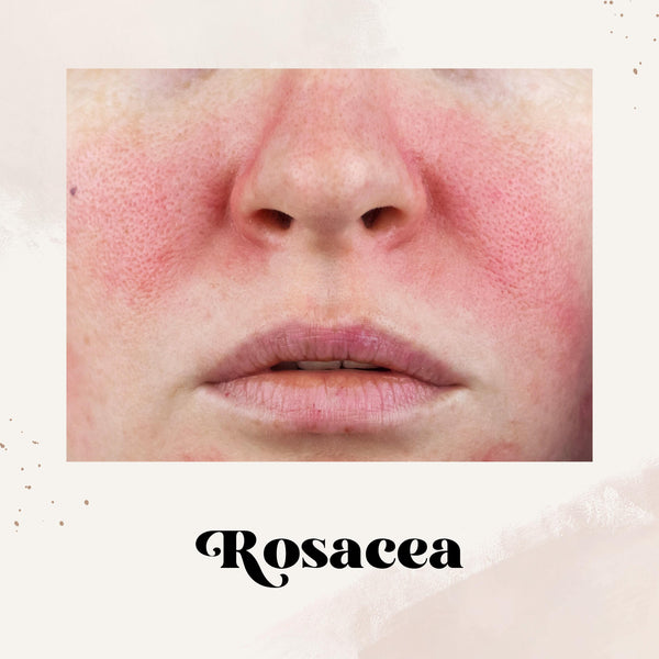 Rosacea
